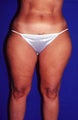 32 Year Old Female Treated with Smart Lipo