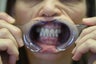 50 year old female treated with All-on-4 Procedure