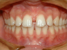 Invisalign
