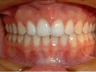 Invisalign