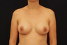 Breast Augmentation