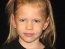 Otoplasty (Ears)