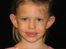 Otoplasty (Ears)