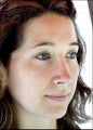 Revision rhinoplasty