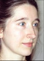 Revision rhinoplasty