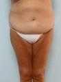 Body Lift