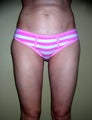 Vaser liposuction