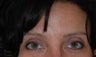 Botox and Dermal Filler to Frown Lines