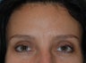 Botox and Dermal Filler to Frown Lines