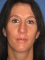 45 Year Old Female Facelift