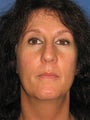 45 Year Old Female Facelift