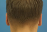 Otoplasty