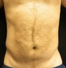 CoolSculpting