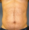 CoolSculpting