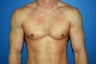 gynecomastia