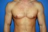 gynecomastia