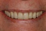 Replacement of worn and broken teeth with full crowns.