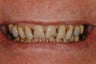 Replacement of worn and broken teeth with full crowns.