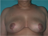 6 Month Post Operative Breast Reduction