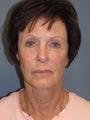 Brow Lift, Fat Transfer, LiteLift™ on 62-year-old Woman