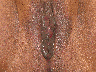 Labiaplasty