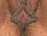 Labiaplasty