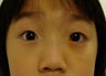Ptosis surgery, asian eyelid surgery
