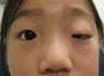 Ptosis surgery, asian eyelid surgery