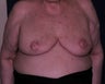 free nipple graft breast reduction