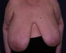 free nipple graft breast reduction