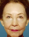 Skin Resurfacing - Before and After