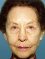 Skin Resurfacing - Before and After