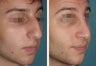 Male Primary Rhinoplasty