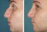 Male Primary Rhinoplasty