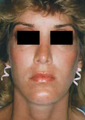 Revision Rhinoplasty