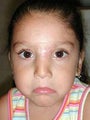 Female Dog Bite Reconstruction