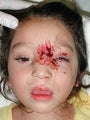Female Dog Bite Reconstruction