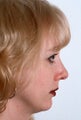 Rhinoplasty