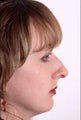 Rhinoplasty