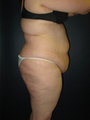 Butt Augmentation