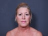 Brow Lift