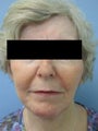 Wrinkle treatment on woman's lip, jaw and cheek areas