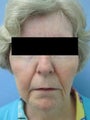 Wrinkle treatment on woman's lip, jaw and cheek areas