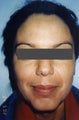 Hispanic woman 30-40 year old treated for Melasma and Acne Scars