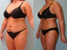 Tummy Tuck: 38-Year-Old Mother