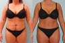 Tummy Tuck: 38-Year-Old Mother