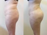 Brazilian Butt Lift