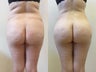 Brazilian Butt Lift