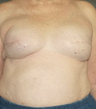 Breast Reconstruction