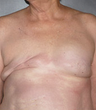 Breast Reconstruction